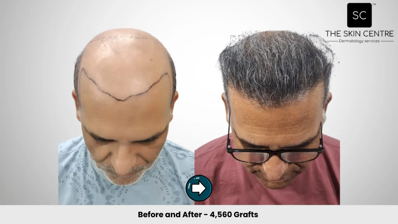 Hair Transplant Case 1