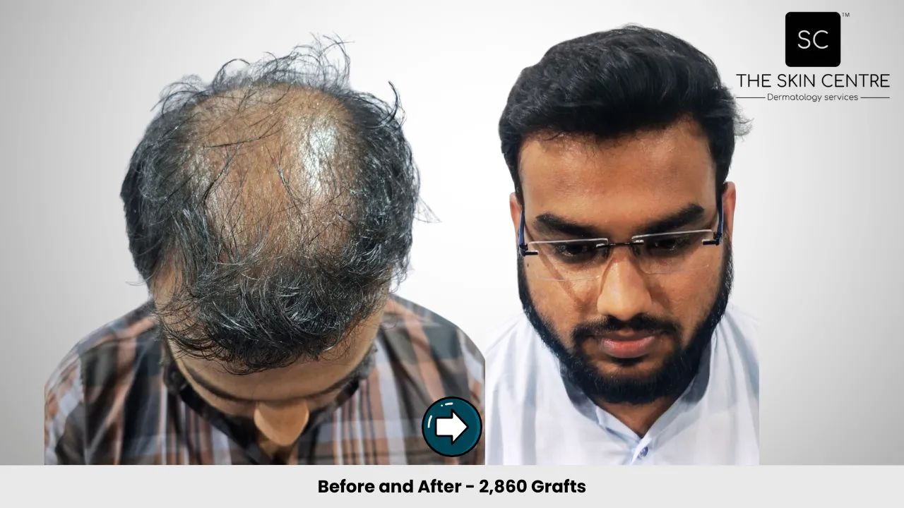 Hair Transplant Case 2