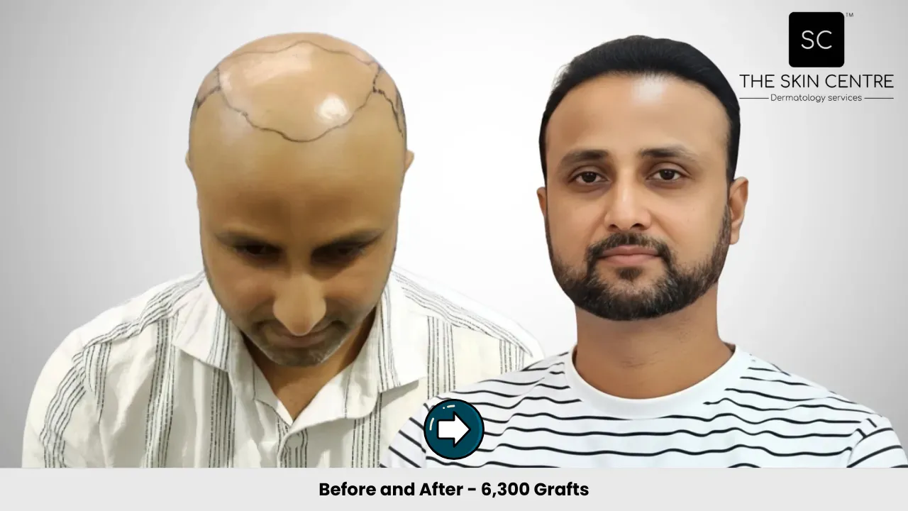 Hair Transplant Case 5