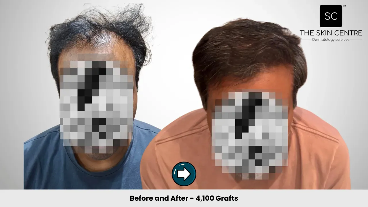 Hair Transplant Case 3