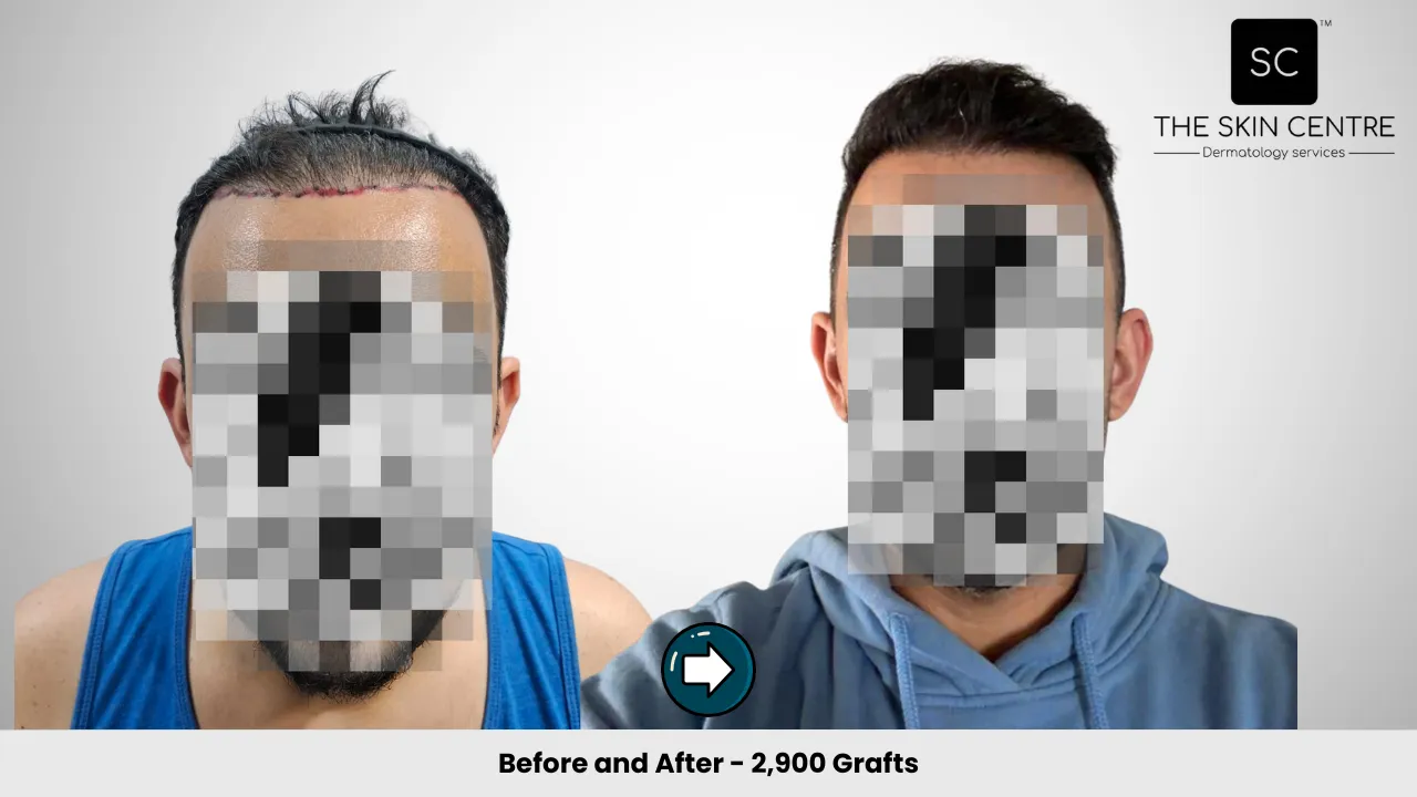 Hair Transplant Case 6