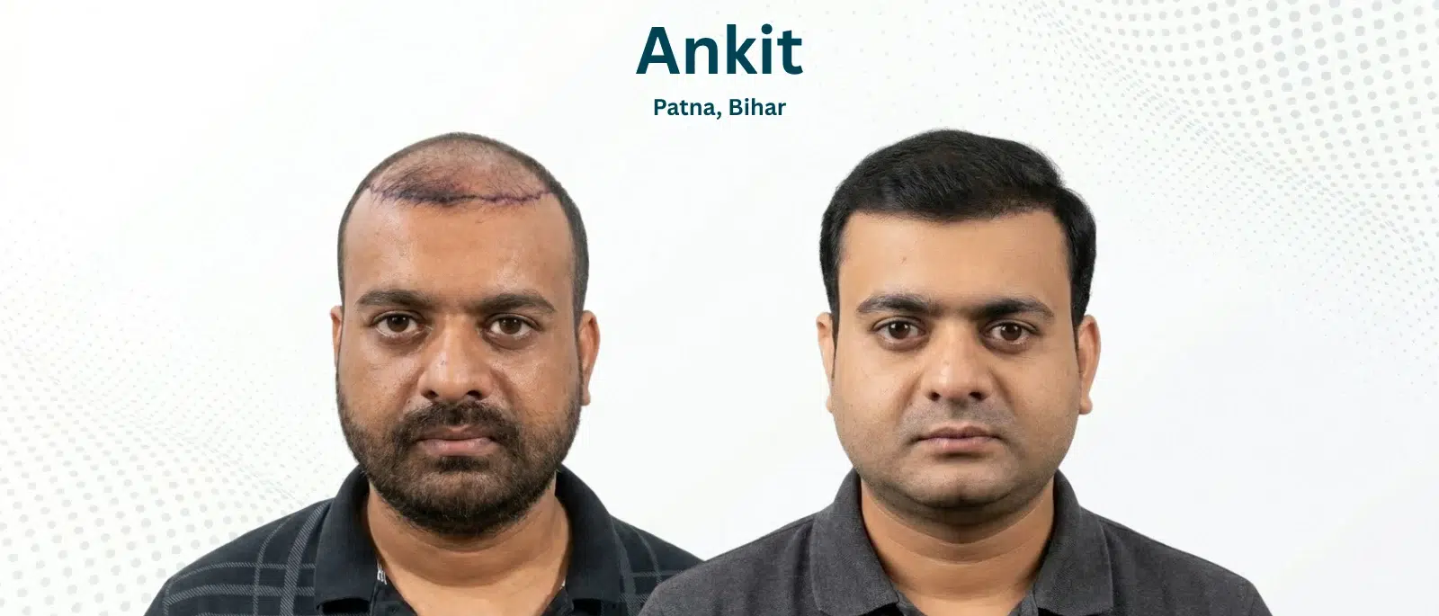 Ankit Before and After Hair Transplant Patna