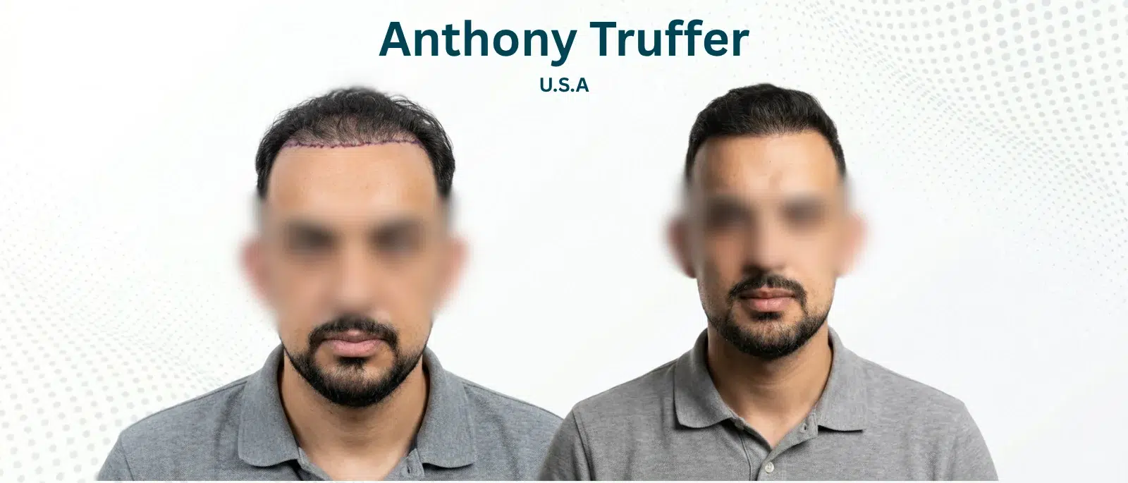 Anthony Truffer Before and After Hair Transplant Patna