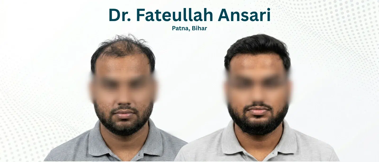 Dr. Fateullah Ansari Before and After Hair Transplant Patna