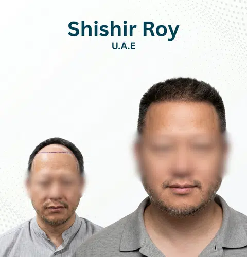 Shishir Roy Before and After Hair Transplant Patna