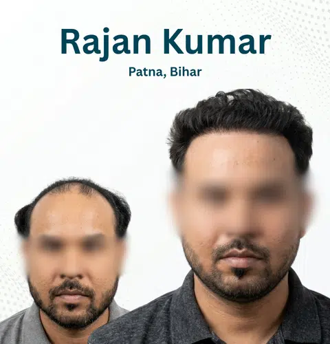 Rajan Kumar Before and After Hair Transplant Patna