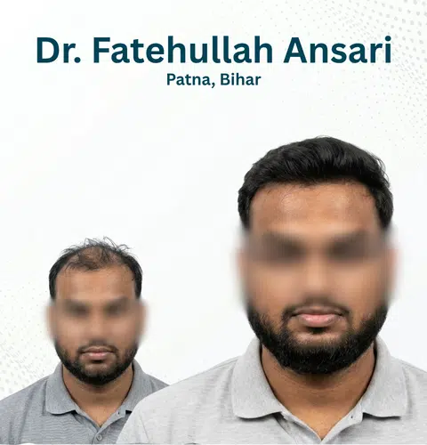 Dr. Fateullah Ansari Before and After Hair Transplant Patna