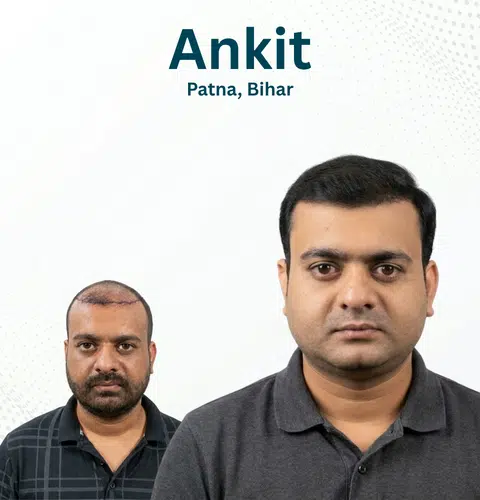 Ankit Before and After Hair Transplant Patna