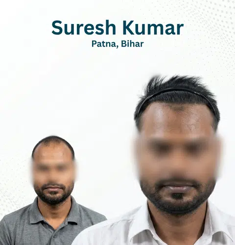 Suresh Kumar Before and After Hair Transplant Patna