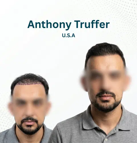 Anthony Truffer Before and After Hair Transplant Patna