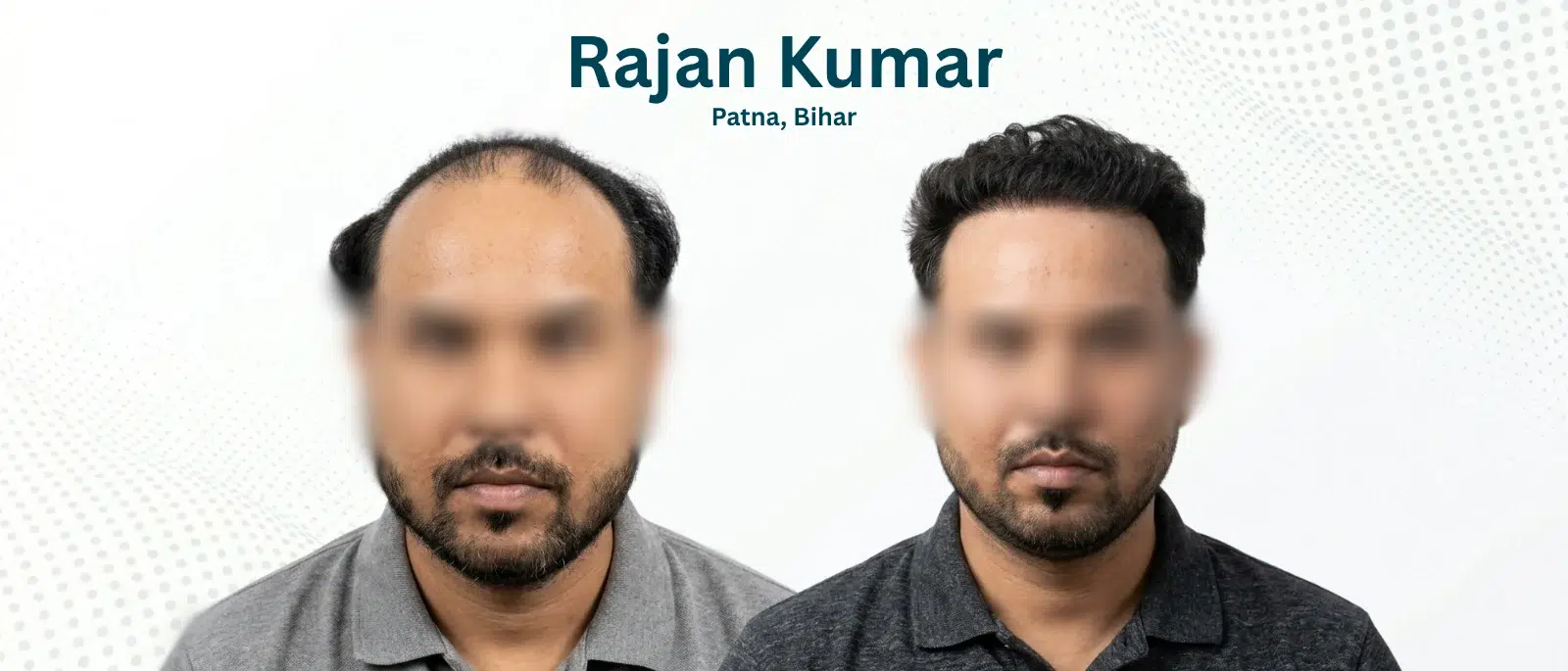 Rajan Kumar Before and After Hair Transplant Patna