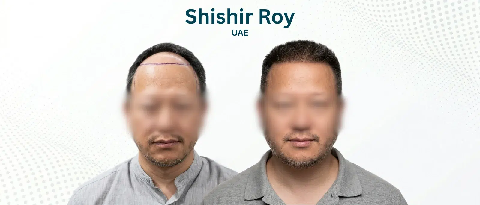 Shishir Roy Before and After Hair Transplant Patna