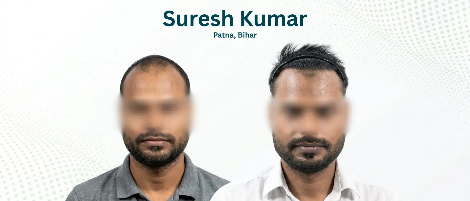 Suresh Kumar Before and After Hair Transplant Patna