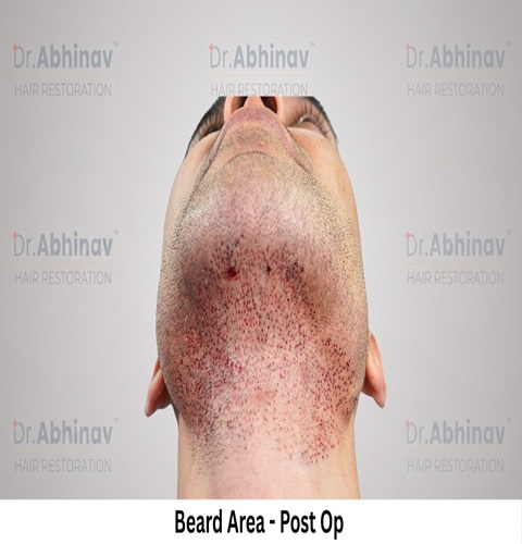 Mr. Benedict Cruz Beard Area Post Op Hair Transplant in Patna