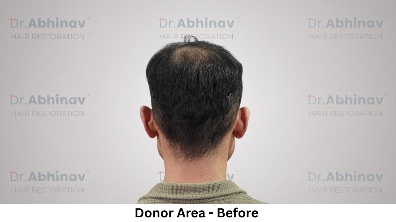 Mr. Benedict Cruz Donor Area Before Hair Transplant in Patna