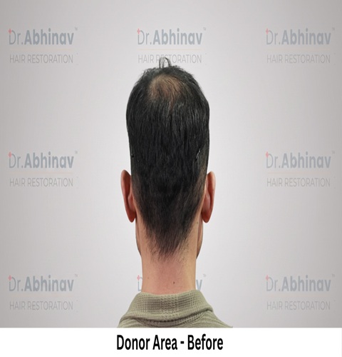 Mr. Benedict Cruz Donor Area Before Hair Transplant in Patna