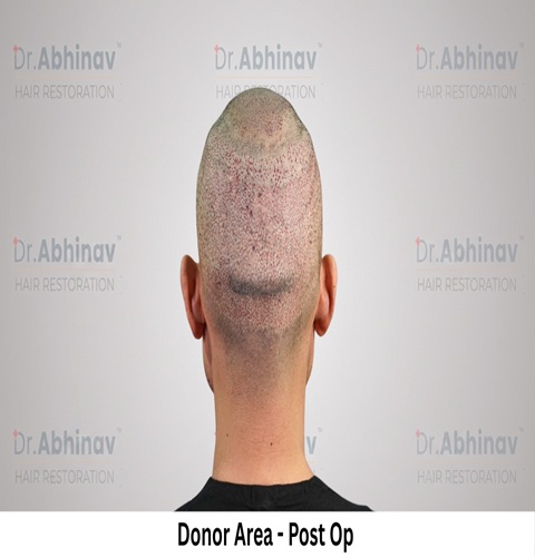 Mr. Benedict Cruz Donor Area Post Op Hair Transplant in Patna
