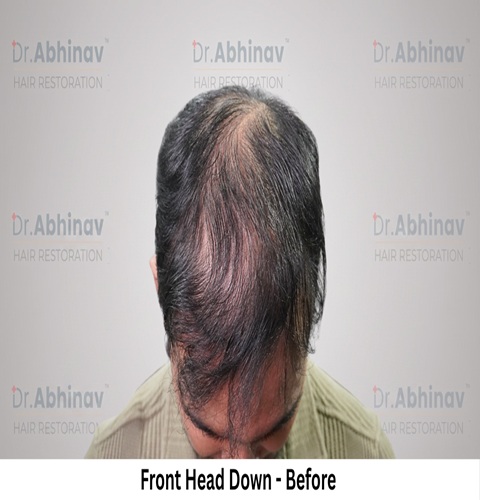 Mr. Benedict Cruz Front Head Down Before Hair Transplant in Patna