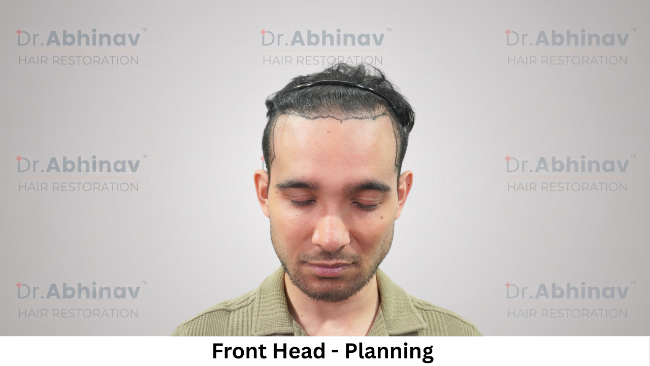 Mr. Benedict Cruz Front Head Planning Hair Transplant in Patna