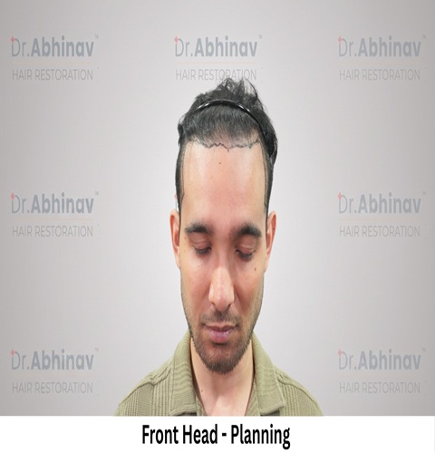 Mr. Benedict Cruz Front Head Planning Hair Transplant in Patna