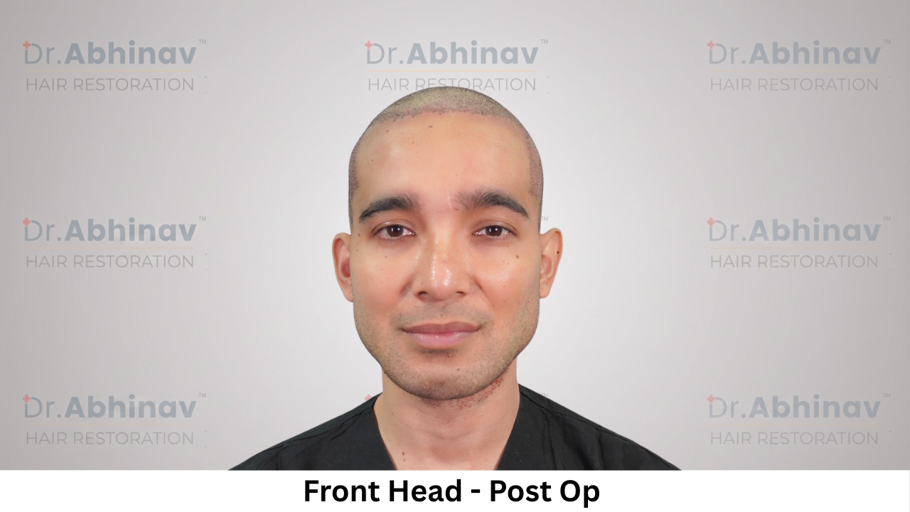 Mr. Benedict Cruz Front Head Post Op Hair Transplant in Patna