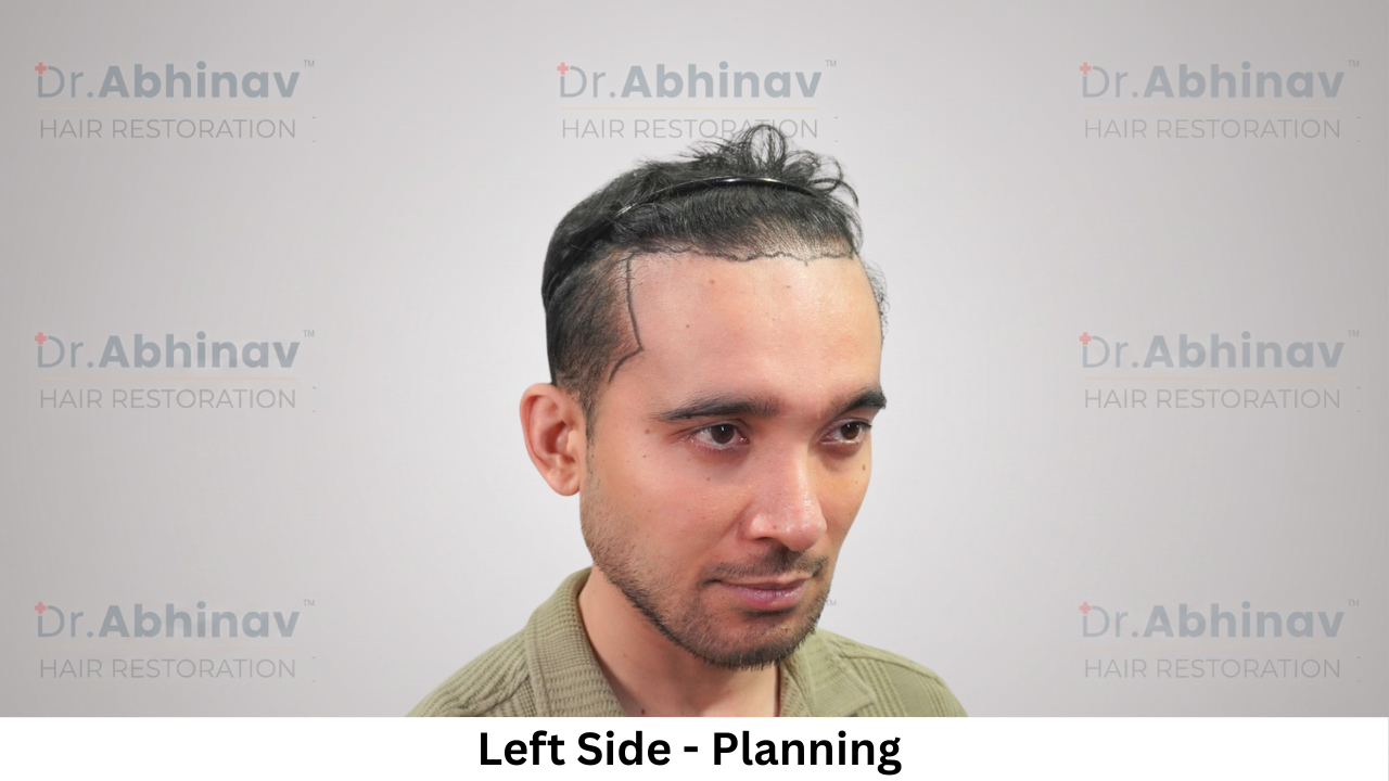 Mr. Benedict Cruz Left Side Planning Hair Transplant in Patna