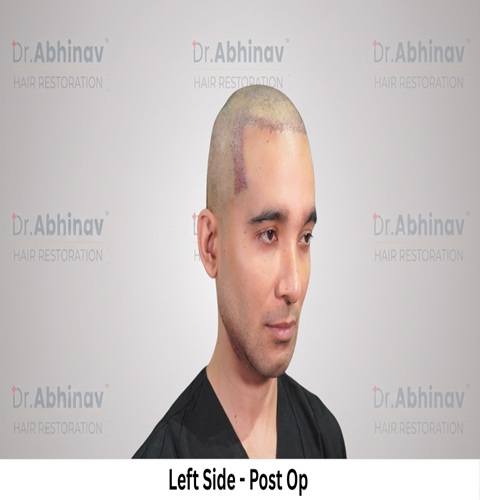 Mr. Benedict Cruz Left Side Post Op Hair Transplant in Patna