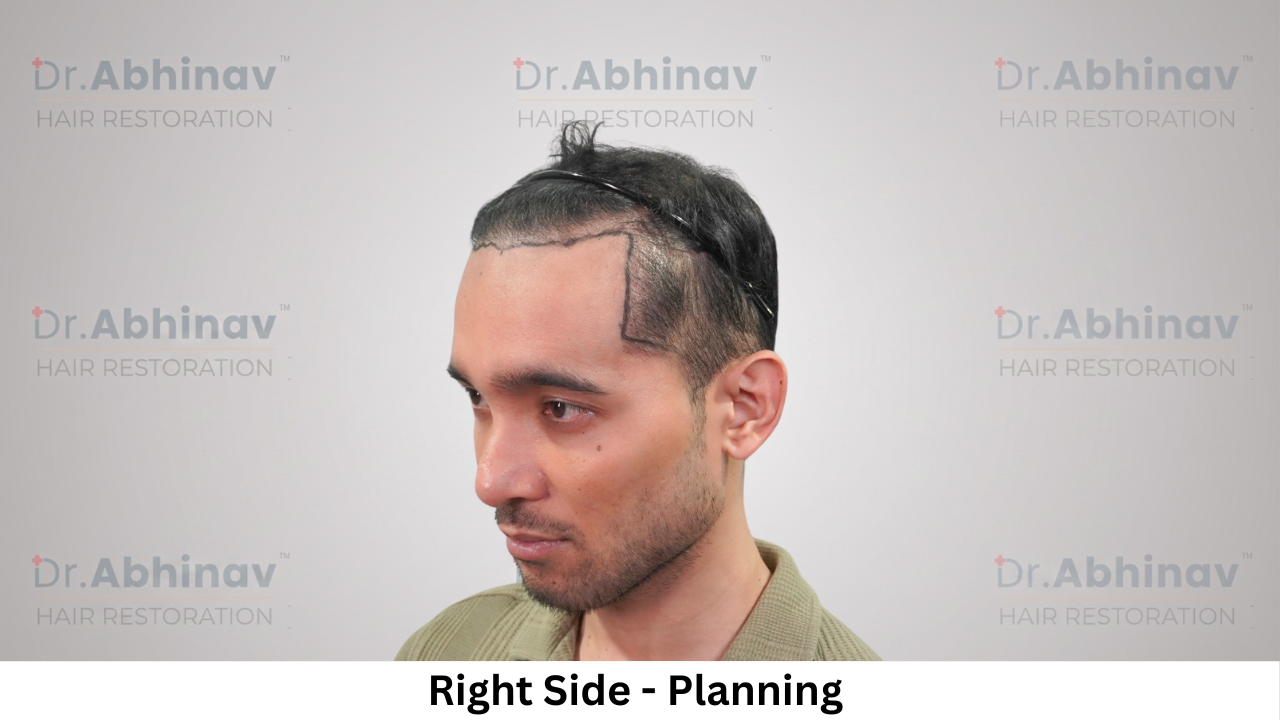 Mr. Benedict Cruz Right Side Planning Hair Transplant in Patna