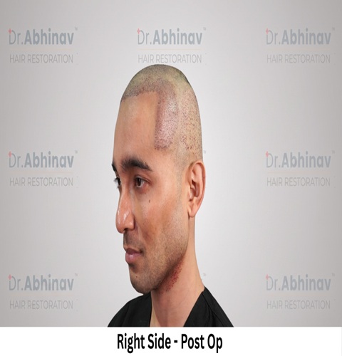 Mr. Benedict Cruz Right Side Post Op Hair Transplant in Patna