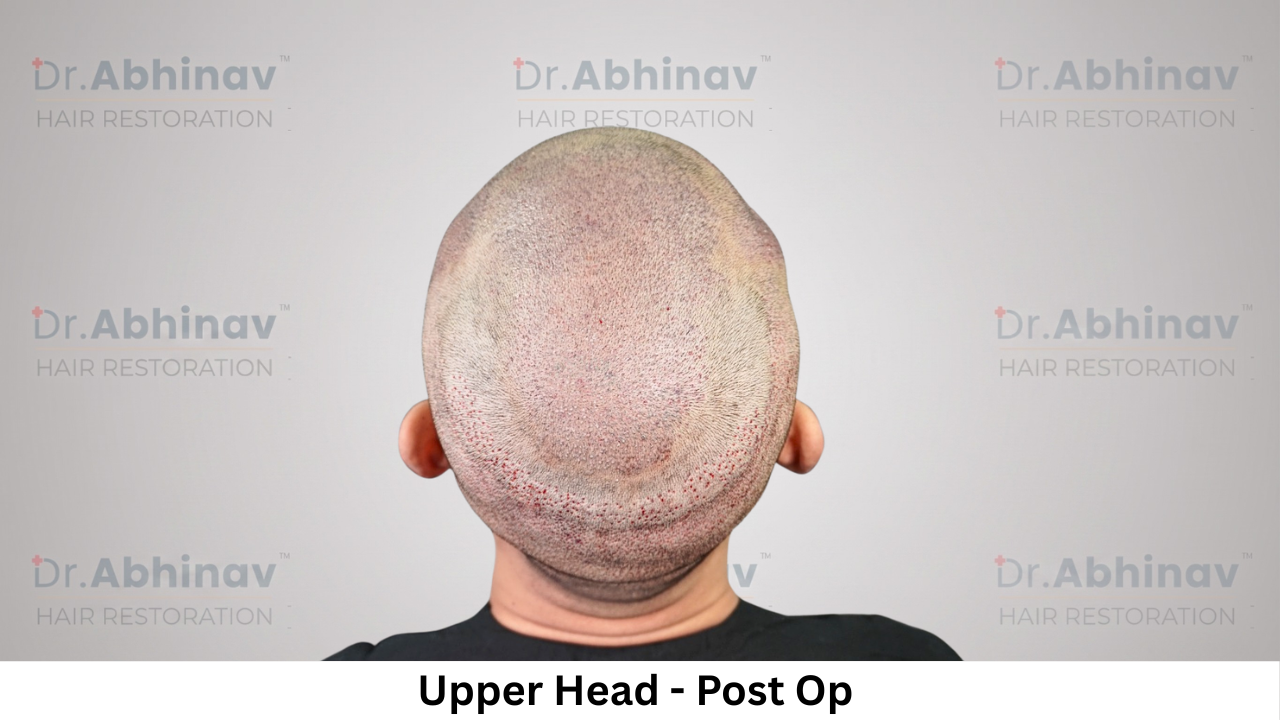Mr. Benedict Cruz Right Side Upper Head Post Op Hair Transplant in Patna