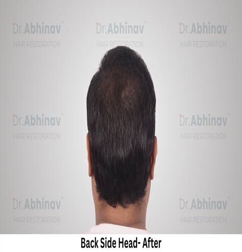 Abhinav Prakash Hair Transplant Back Side Head View After - Patna