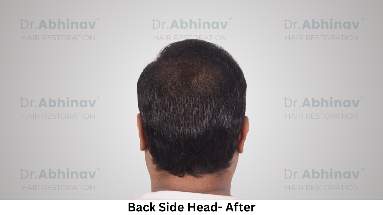 Abhinav Prakash Hair Transplant Back Side Head View After - Patna
