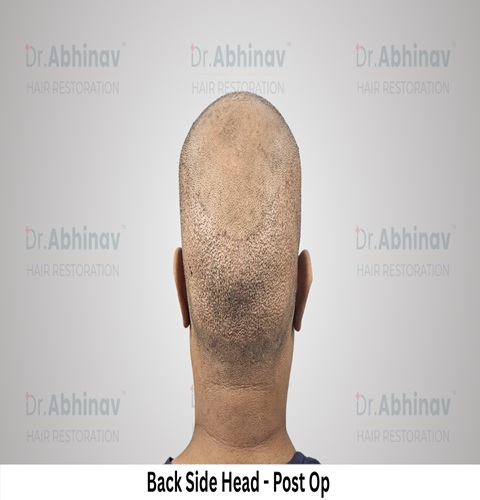 Abhinav Prakash Hair Transplant Back Side Head View Post Op - Patna