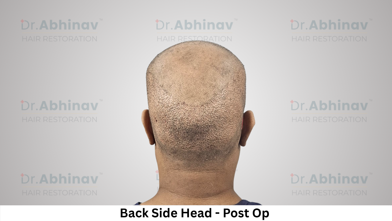 Abhinav Prakash Hair Transplant Back Side Head View Post Op - Patna