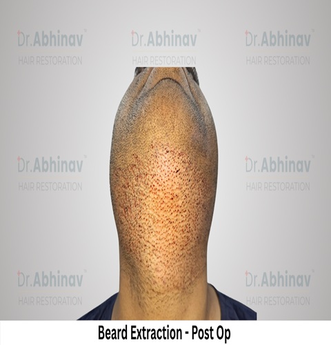 Abhinav Prakash Hair Transplant Beard Extraction View Post Op - Patna