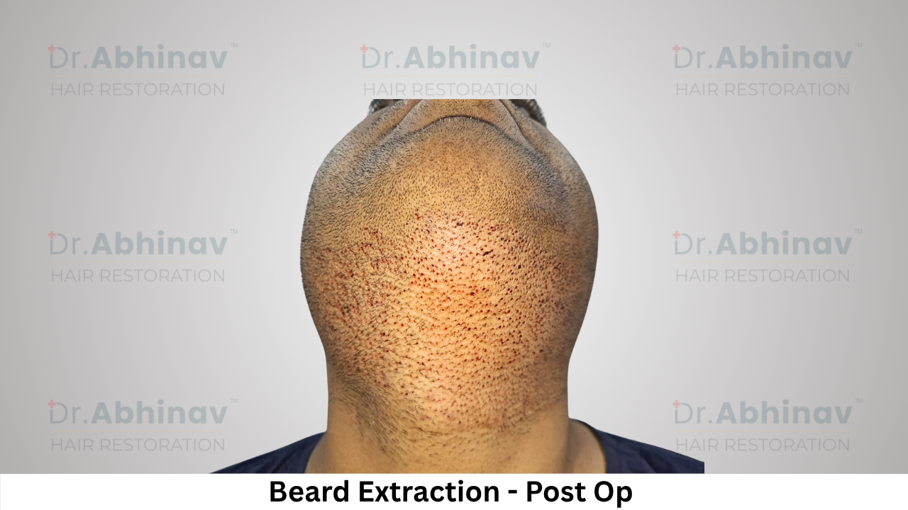Abhinav Prakash Hair Transplant Beard Extraction View Post Op - Patna