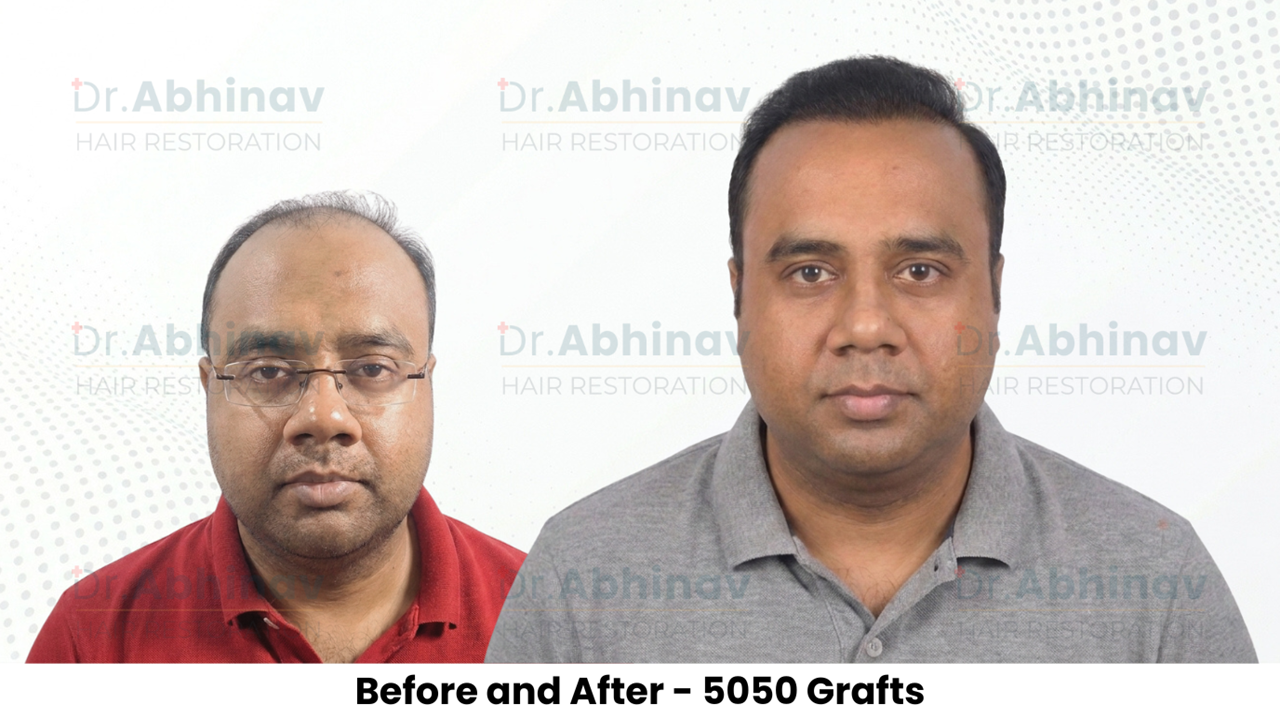 Abhinav Prakash Hair Transplant Before and After Result - Patna