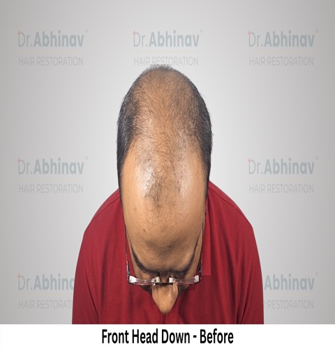Abhinav Prakash Hair Transplant Front Head Down View Before - Patna