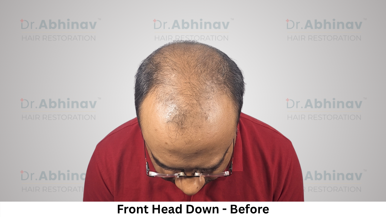 Abhinav Prakash Hair Transplant Front Head Down View Before - Patna