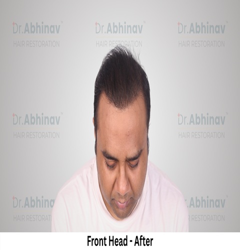 Abhinav Prakash Hair Transplant Front Head View After - Patna