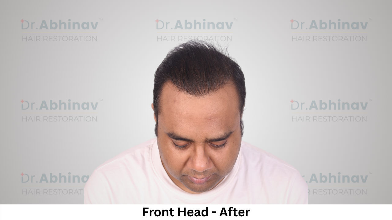 Abhinav Prakash Hair Transplant Front Head View After - Patna