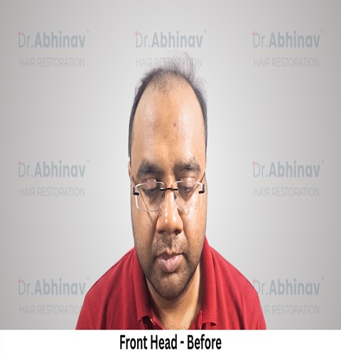 Abhinav Prakash Hair Transplant Front Head View Before - Patna