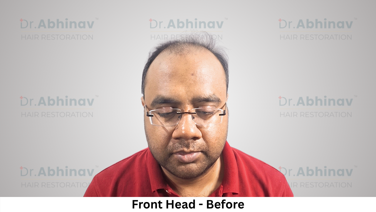 Abhinav Prakash Hair Transplant Front Head View Before - Patna