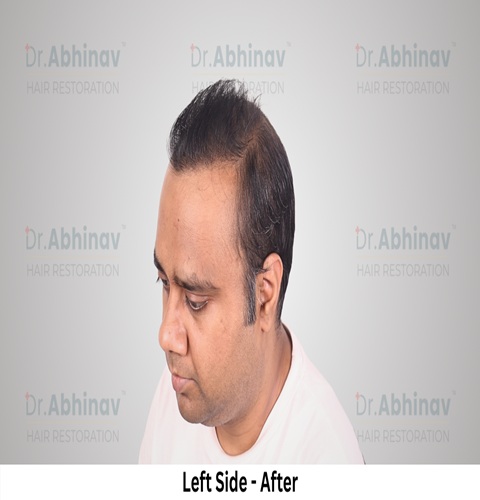 Abhinav Prakash Hair Transplant Left Side View After - Patna