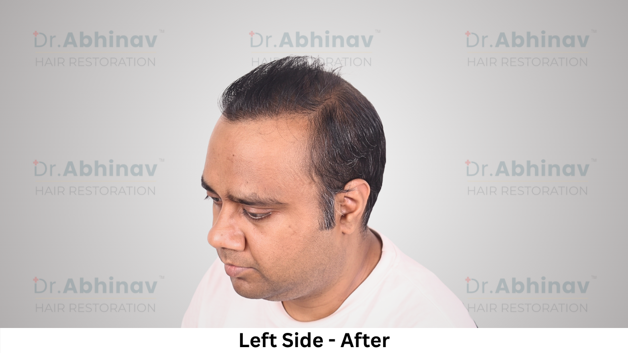Abhinav Prakash Hair Transplant Left Side View After - Patna