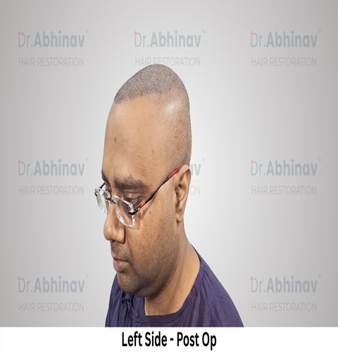 Abhinav Prakash Hair Transplant Left Side View Post Op - Patna