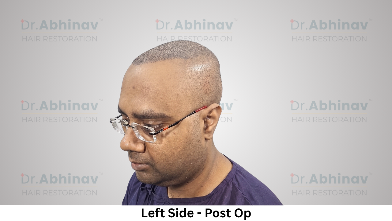 Abhinav Prakash Hair Transplant Left Side View Post Op - Patna
