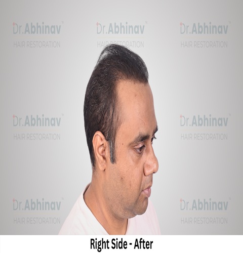 Abhinav Prakash Hair Transplant Right Side View After - Patna