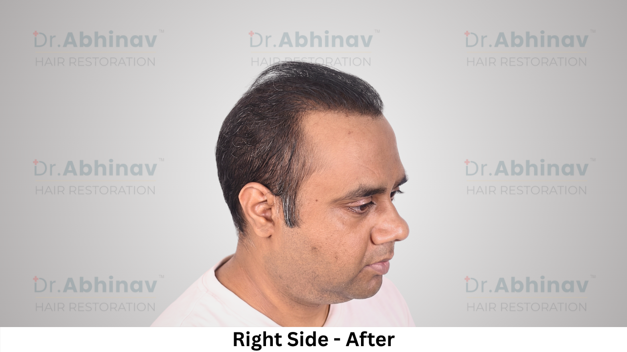 Abhinav Prakash Hair Transplant Right Side View After - Patna