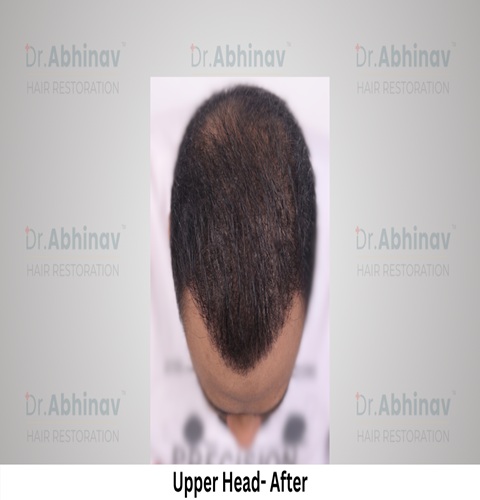 Abhinav Prakash Hair Transplant Upper Head View after - Patna